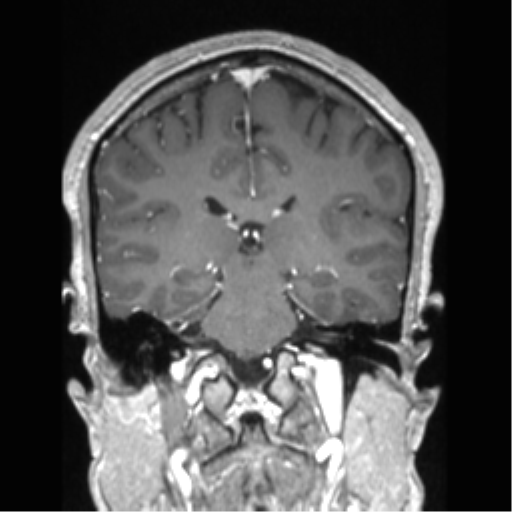 Cerebral arteriovenous malformation (Radiopaedia 39259-41506 Coronal T1 C+ 42).png