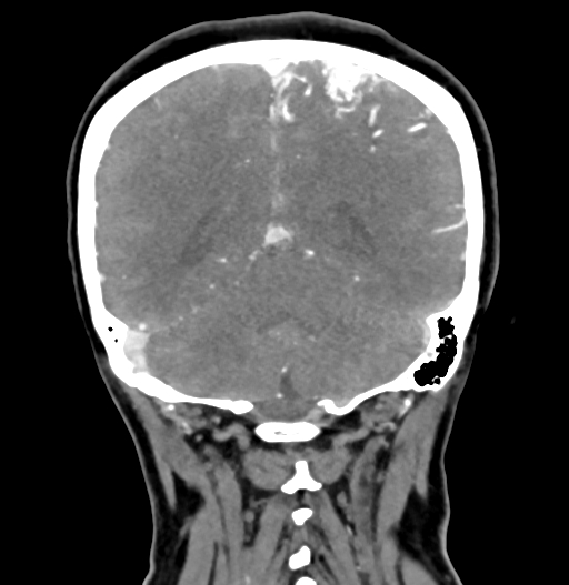 Cerebral arteriovenous malformation (Radiopaedia 73830-84645 C 71).jpg