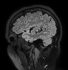 Cerebral arteriovenous malformation (Radiopaedia 74411-85654 Sagittal FLAIR 22).jpg