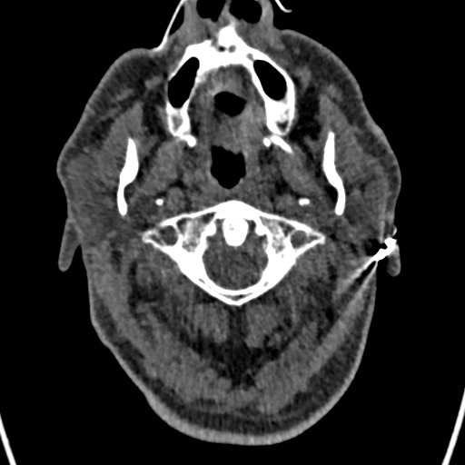 File:Cerebral arteriovenous malformation (Radiopaedia 78188-90746 Axial non-contrast 2).jpg