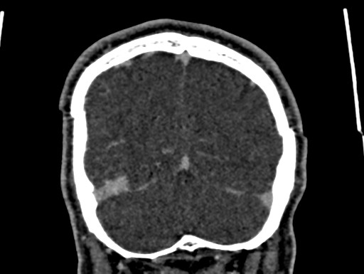 Cerebral arteriovenous malformation (Radiopaedia 78188-90746 Coronal C+ delayed 106).jpg
