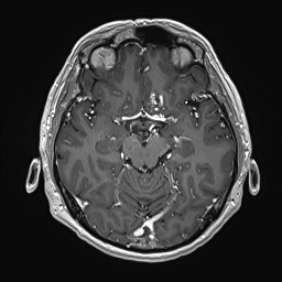 Cerebral arteriovenous malformation (Radiopaedia 84015-99245 Axial T1 C+ 66).jpg