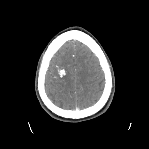 File:Cerebral arteriovenous malformation (Spetzler-Martin grade 2) (Radiopaedia 41262-44076 Axial C+ 42).png