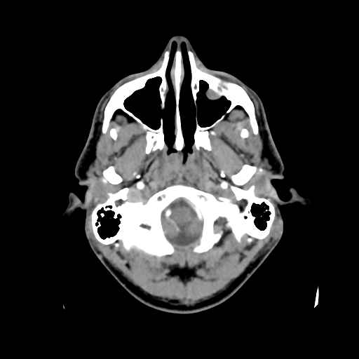 Cerebral arteriovenous malformation (Spetzler-Martin grade 2) (Radiopaedia 41262-44076 Axial C+ 5).png