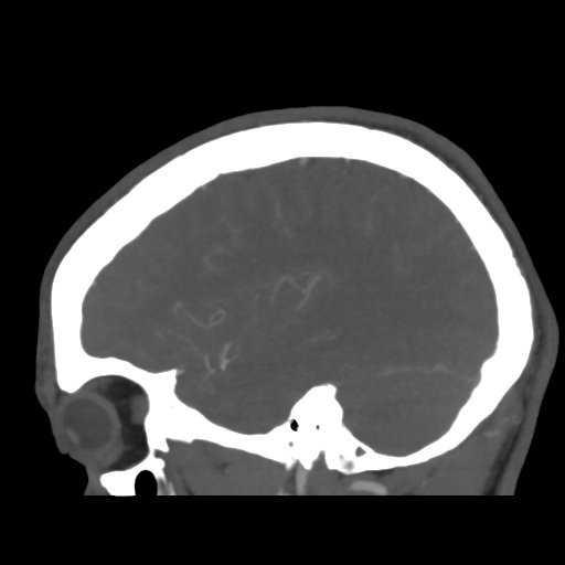 Cerebral arteriovenous malformation (Spetzler-Martin grade 2) (Radiopaedia 41262-44076 G 40).png