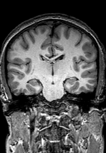 File:Cerebral arteriovenous malformation at posterior body of corpus callosum (Radiopaedia 74111-84925 Coronal T1 181).jpg