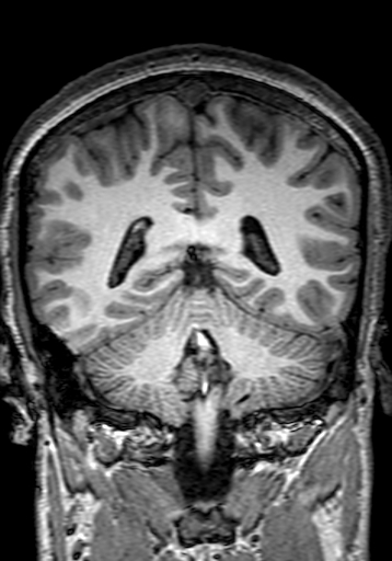 File:Cerebral arteriovenous malformation at posterior body of corpus callosum (Radiopaedia 74111-84925 Coronal T1 232).jpg