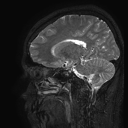 Cerebral arteriovenous malformation at posterior body of corpus callosum (Radiopaedia 74111-84925 Sagittal T2 50).jpg