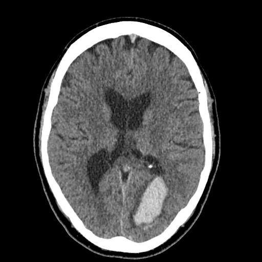 Cerebral arteriovenous malformation with lobar hemorrhage (Radiopaedia 35598-37117 Axial non-contrast 30).jpg