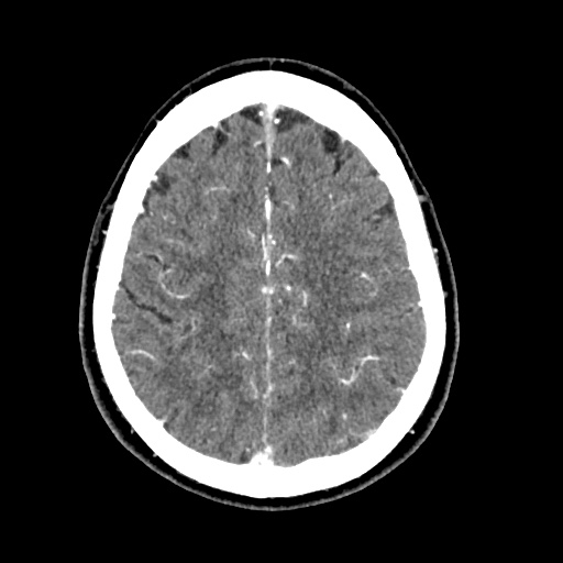 Cerebral arteriovenous malformation with lobar hemorrhage (Radiopaedia 35598-57216 A 47).jpg