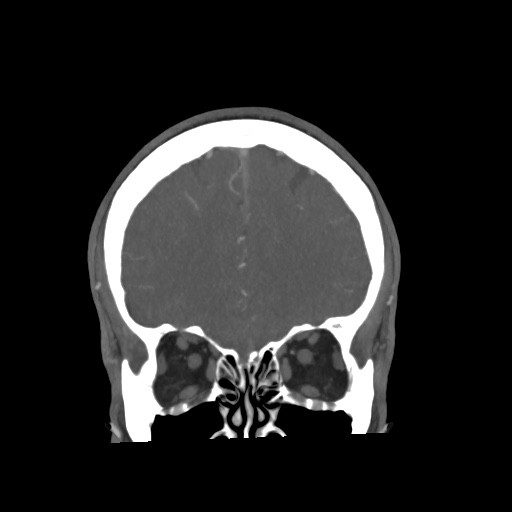 Cerebral arteriovenous malformation with lobar hemorrhage (Radiopaedia 35598-57216 C 22).jpg