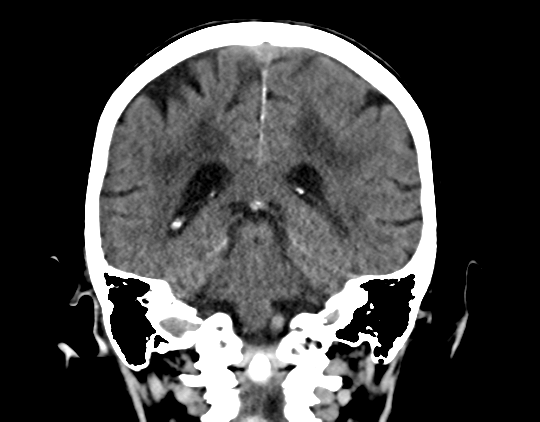Cerebral arteriovenous malformation with lobar hemorrhage (Radiopaedia 44725-48510 Coronal non-contrast 32).png