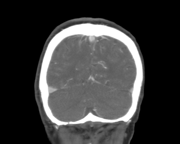 Cerebral arteriovenous malformation with lobar hemorrhage (Radiopaedia 44725-48511 A 49).png