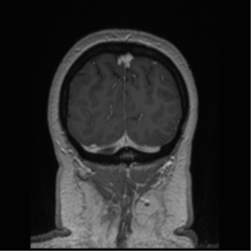 Cerebral cavernoma and development venous anomaly (Radiopaedia 37603-39482 Coronal T1 C+ 14).png