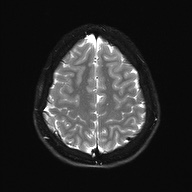 Cerebral cavernous venous malformation (Radiopaedia 70008-80021 Axial DWI 25).jpg