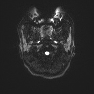 Cerebral cavernous venous malformation (Radiopaedia 70008-80021 Axial DWI 31).jpg
