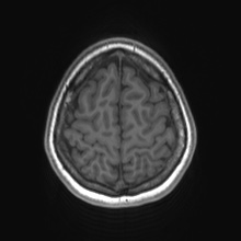 Cerebral cavernous venous malformation (Radiopaedia 70008-80021 Axial T1 77).jpg