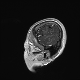 Cerebral cavernous venous malformation (Radiopaedia 70008-80021 Sagittal T1 C+ 6).jpg
