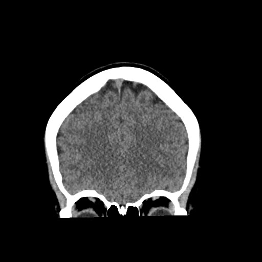 Cerebral cavernous venous malformation (Radiopaedia 70008-80022 non-contrast 18).jpg