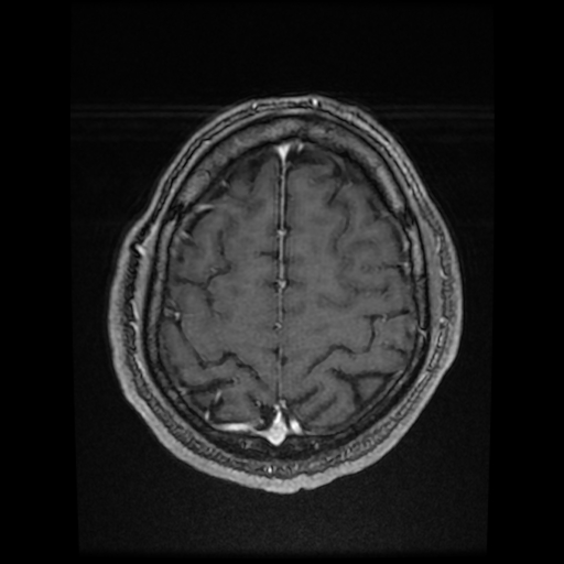 Cerebral cavernous venous malformation (Zabramski type II) (Radiopaedia 85511-101198 Axial T1 C+ fat sat 21).jpg