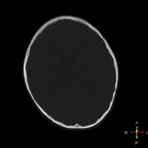 File:Cerebral contusion (Radiopaedia 48869-53911 Axial bone window 9).jpg
