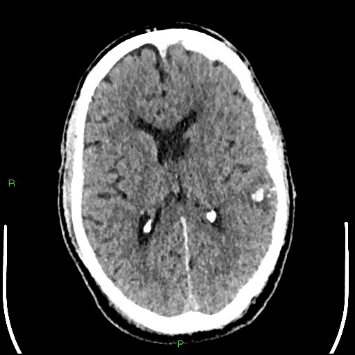 Cerebral contusions (Radiopaedia 33868-35039 Axial non-contrast 117).jpg