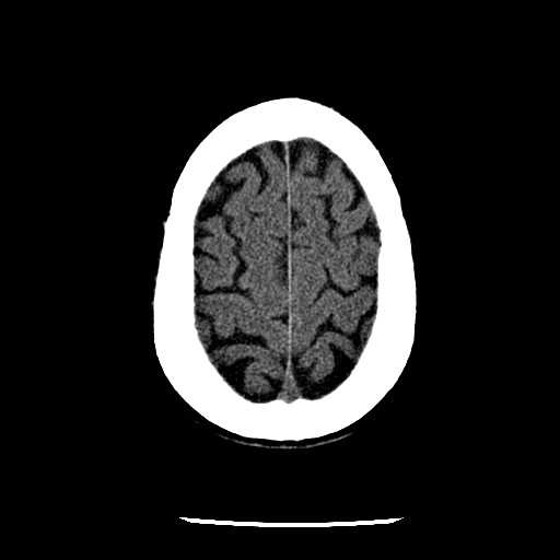 File:Cerebral edema (evolution in time) (Radiopaedia 19418-19441 non-contrast 79).jpg