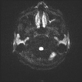 Cerebral embolic infarcts (embolic shower) (Radiopaedia 72391-82921 Axial DWI 31).jpg