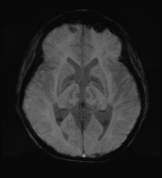 Cerebral embolic infarcts (embolic shower) (Radiopaedia 72391-82921 Axial SWI 35).jpg