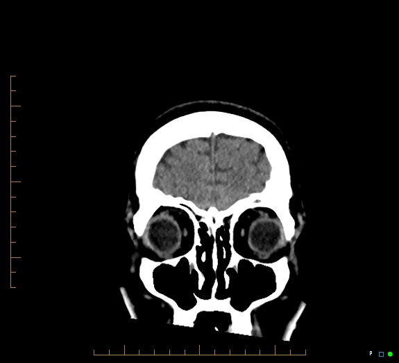Cerebral fat embolism (Radiopaedia 85521-101220 Coronal non-contrast 11).jpg