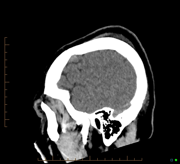 Cerebral fat embolism (Radiopaedia 85521-101224 C 9).jpg