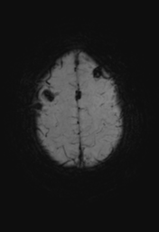 File:Cerebral hemorrhagic contusions- temporal evolution (Radiopaedia 40224-42757 Axial SWI 28).png