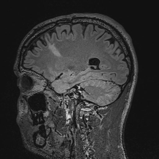 File:Cerebral hemorrhagic contusions- temporal evolution (Radiopaedia 40224-42757 Sagittal T1 28).png