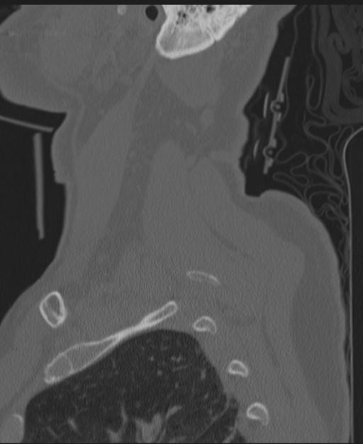Cerebral hemorrhagic contusions and cervical spine fractures (Radiopaedia 32865-33841 Sagittal bone window 11).jpg