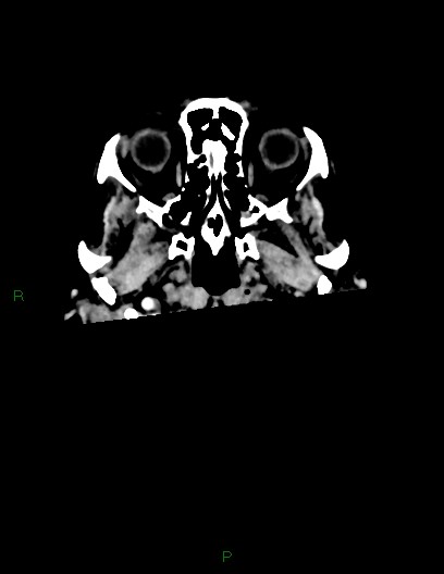 Cerebral metastases - ependymal and parenchymal (Radiopaedia 79877-93131 Axial C+ delayed 2).jpg