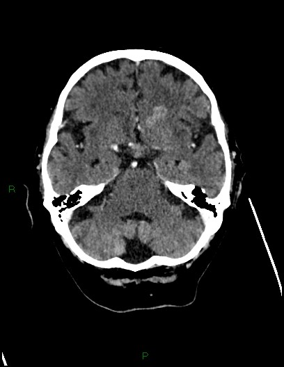 Cerebral metastases - ependymal and parenchymal (Radiopaedia 79877-93131 Axial C+ delayed 24).jpg