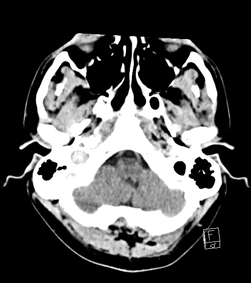Cerebral metastases - testicular choriocarcinoma (Radiopaedia 84486-99855 Axial C+ delayed 47).jpg