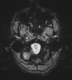 Cerebral metastasis - melanoma (Radiopaedia 54718-60954 Axial SWI 4).png