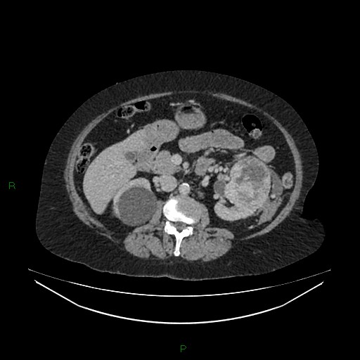 File:Cerebral metastasis from renal cell carcinoma (Radiopaedia 82306-96378 A 74).jpg