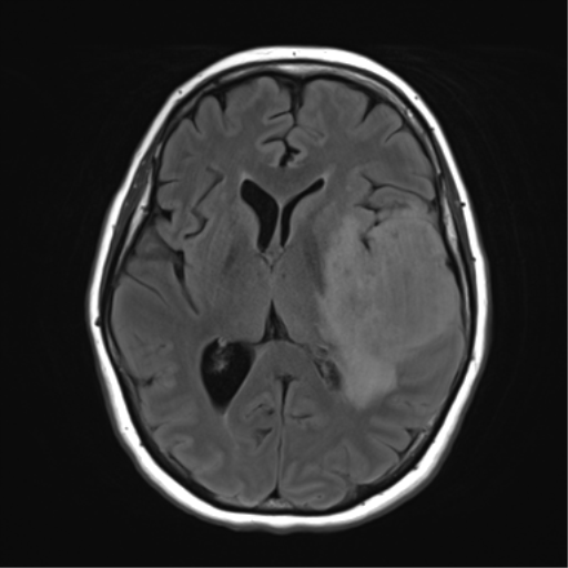 File:Cerebral metastasis mimicking glioblastoma (Radiopaedia 69155-78937 Axial FLAIR 18).png