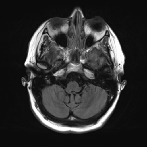 File:Cerebral metastasis mimicking glioblastoma (Radiopaedia 69155-78937 Axial FLAIR 8).png