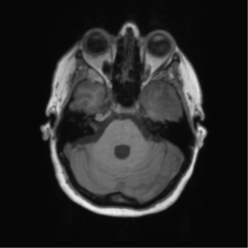 File:Cerebral metastasis mimicking glioblastoma (Radiopaedia 69155-78937 Axial T1 14).png