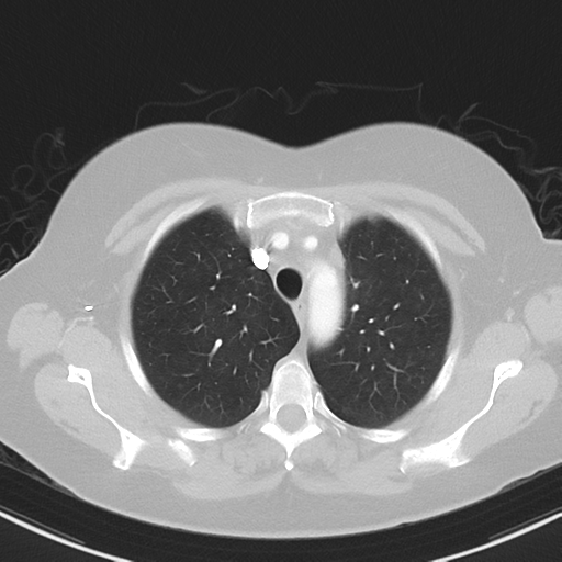 File:Cerebral metastasis mimicking glioblastoma (Radiopaedia 69155-78938 Axial lung window 9).png