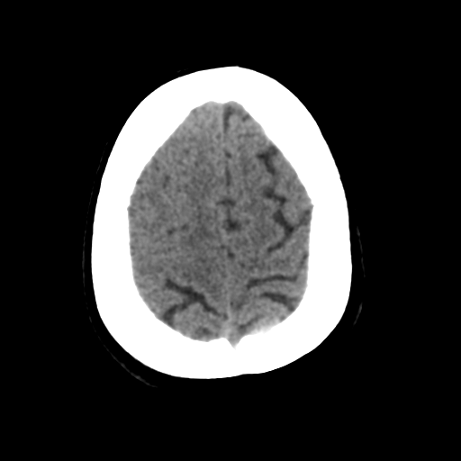 Cerebral metastasis to basal ganglia (Radiopaedia 81568-95412 Axial non-contrast 51).png