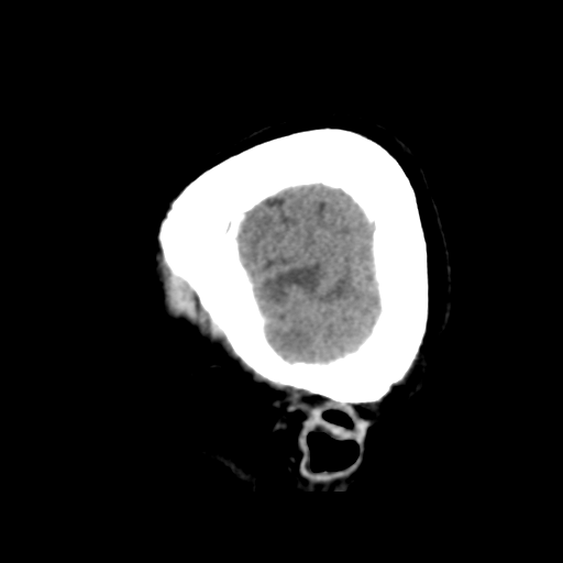 Cerebral metastasis to basal ganglia (Radiopaedia 81568-95412 E 10).png