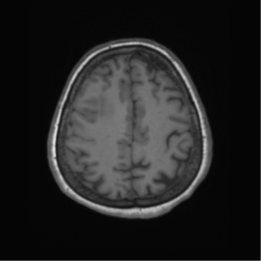 Cerebral metastasis to basal ganglia (Radiopaedia 81568-95413 Axial T1 57).png