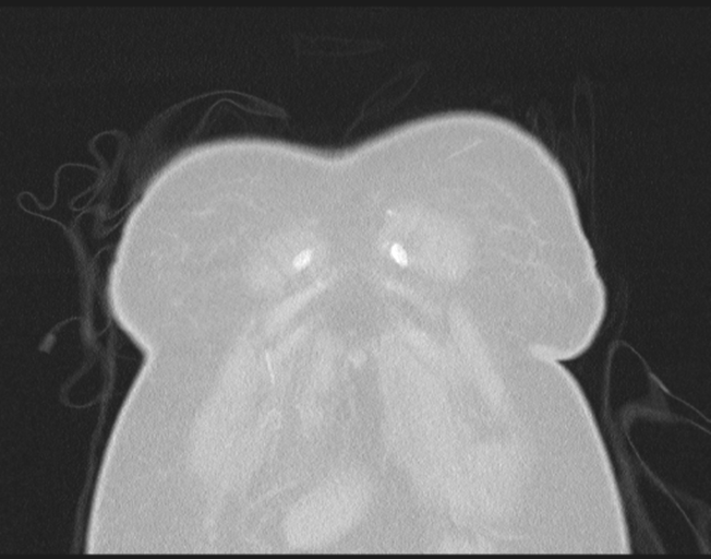 Cerebral metastasis to basal ganglia (Radiopaedia 81568-95414 Coronal lung window 10).png