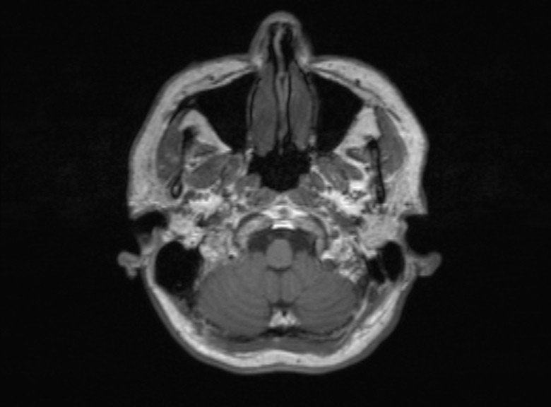Cerebral ring enhancing lesions - cerebral metastases (Radiopaedia 44922-48817 Axial T1 342).jpg