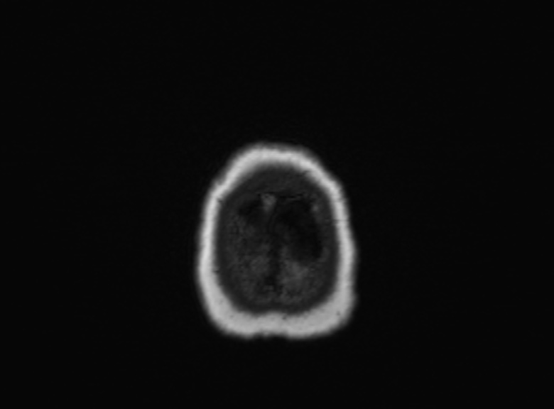 Cerebral ring enhancing lesions - cerebral metastases (Radiopaedia 44922-48817 Axial T1 90).jpg