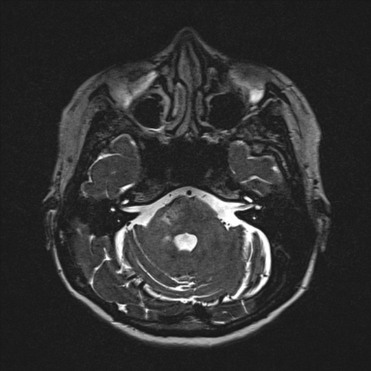 Cerebral ring enhancing lesions - cerebral metastases (Radiopaedia 44922-48817 F 38).jpg